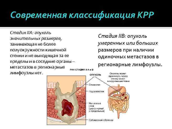 Современная классификация КРР Стадия IIА: опухоль значительных размеров, занимающая не более полуокружности кишечной стенки