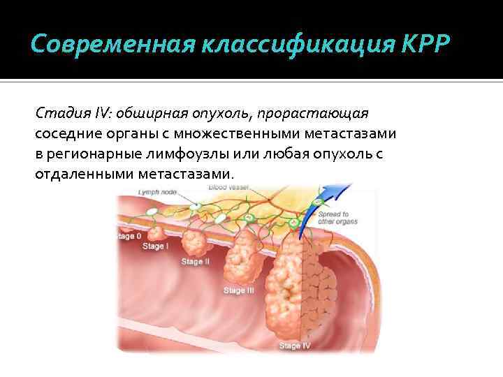 Современная классификация КРР Стадия IV: обширная опухоль, прорастающая соседние органы с множественными метастазами в