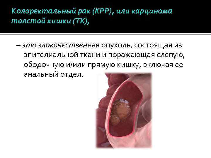 Колоректальный рак (КРР), или карцинома толстой кишки (ТК), – это злокачественная опухоль, состоящая из