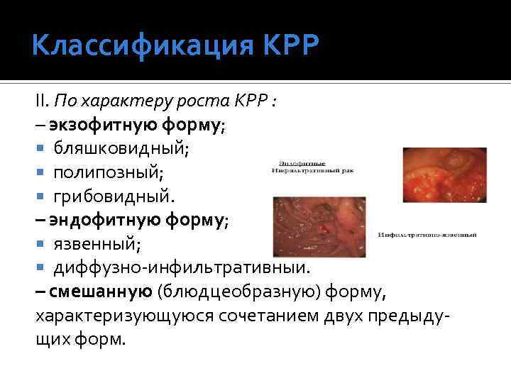 Классификация КРР II. По характеру роста КРР : – экзофитную форму; бляшковидный; полипозный; грибовидный.