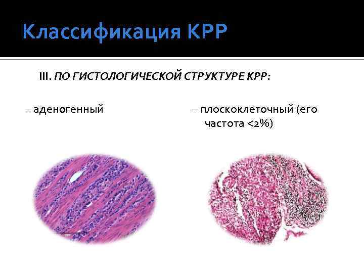 Классификация КРР III. ПО ГИСТОЛОГИЧЕСКОЙ СТРУКТУРЕ КРР: – аденогенный – плоскоклеточный (его частота <2%)