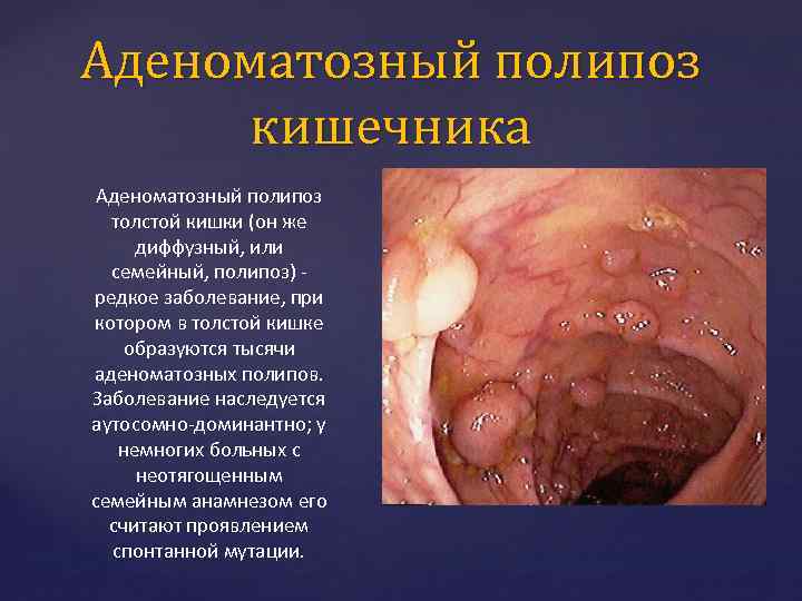 Аденоматозный полипоз кишечника Аденоматозный полипоз толстой кишки (он же диффузный, или семейный, полипоз) редкое