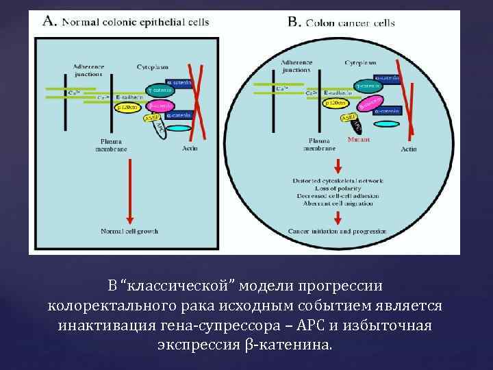 В “классической” модели прогрессии колоректального рака исходным событием является инактивация гена‑супрессора – АРС и