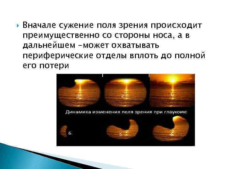  Вначале сужение поля зрения происходит преимущественно со стороны носа, а в дальнейшем –может