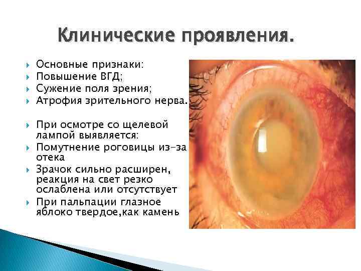Клинические проявления. Основные признаки: Повышение ВГД; Сужение поля зрения; Атрофия зрительного нерва. При осмотре