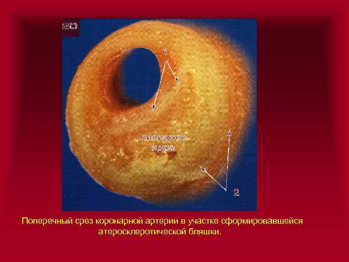 Атеросклероз аорты. Атеросклероз коронарных артерий препарат. Атеросклероз аорты макропрепарат. Атеросклероз коронарных артерий макропрепарат. Атеросклероз сосудов макропрепарат.