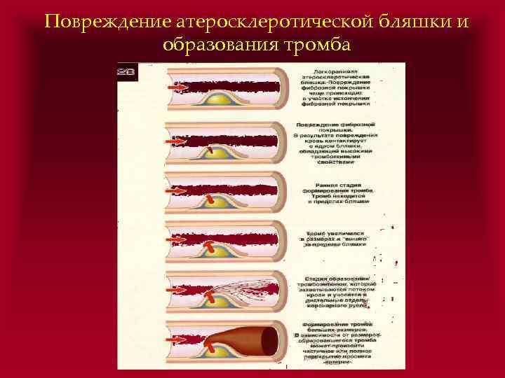 Повреждение атеросклеротической бляшки и образования тромба 