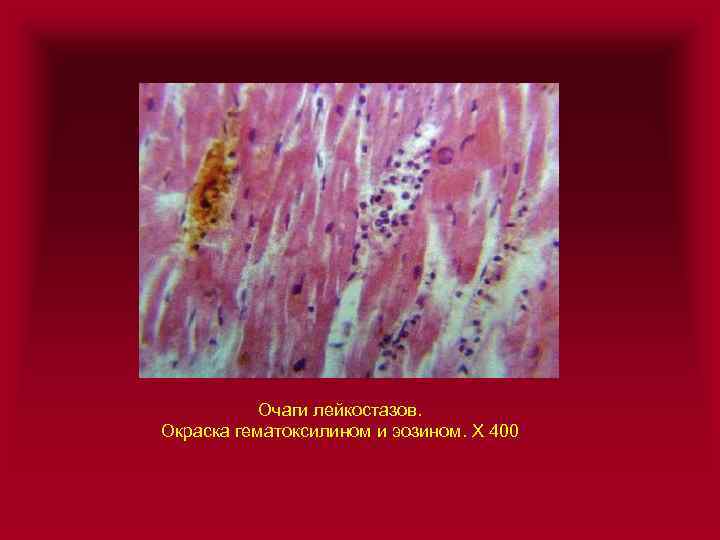 Очаги лейкостазов. Окраска гематоксилином и эозином. Х 400 