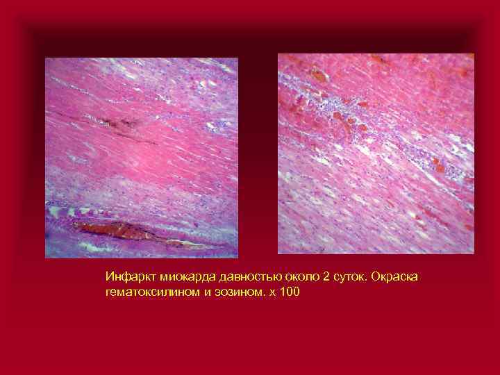 Инфаркт миокарда давностью около 2 суток. Окраска гематоксилином и эозином. х 100 