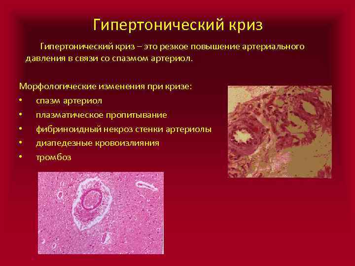 Гипертонический криз – это резкое повышение артериального давления в связи со спазмом артериол. Морфологические