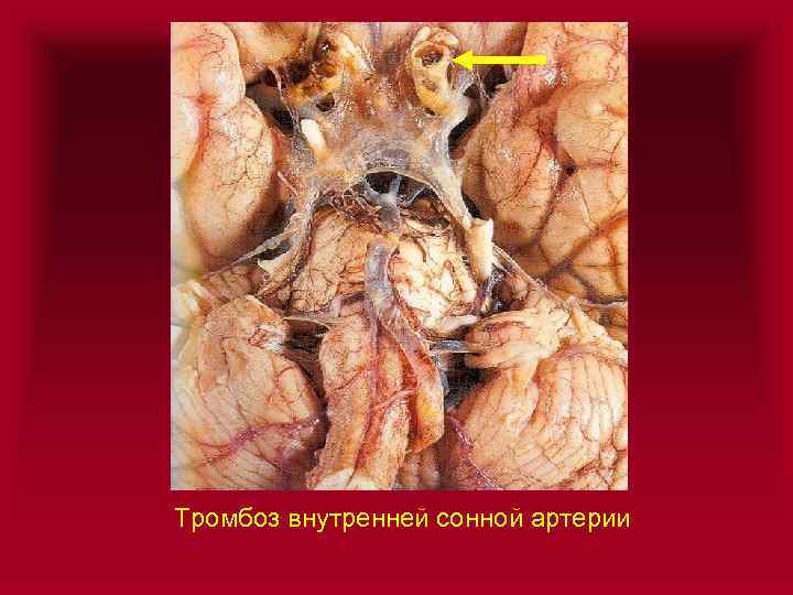 Тромбоз внутренней сонной артерии 