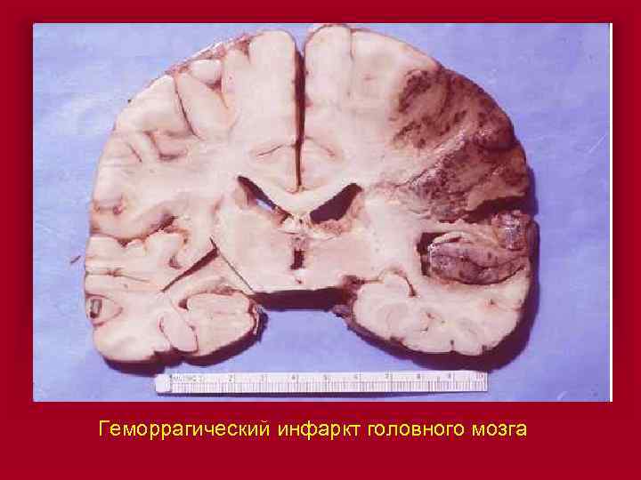 Геморрагический инфаркт головного мозга 