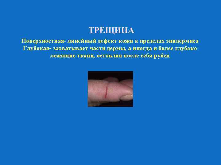 ТРЕЩИНА Поверхностная- линейный дефект кожи в пределах эпидермиса Глубокая- захватывает части дермы, а иногда