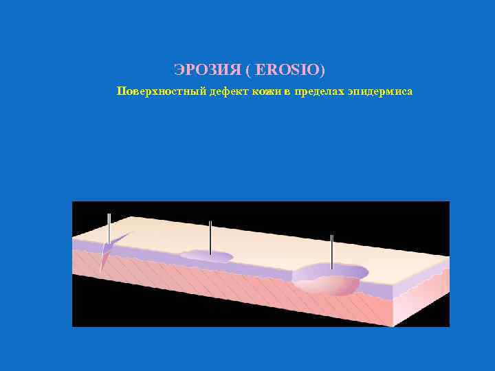 ЭРОЗИЯ ( EROSIO) Поверхностный дефект кожи в пределах эпидермиса 