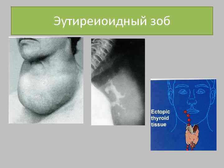 Эутиреиоидный зоб 