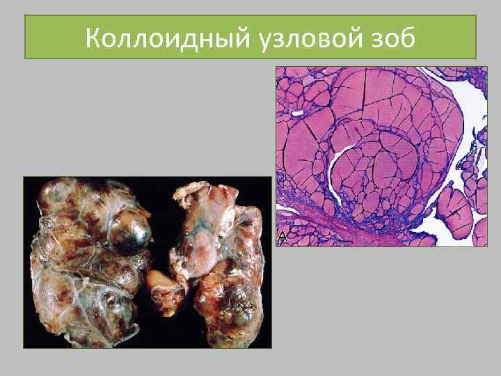 Коллоидный узловой зоб 