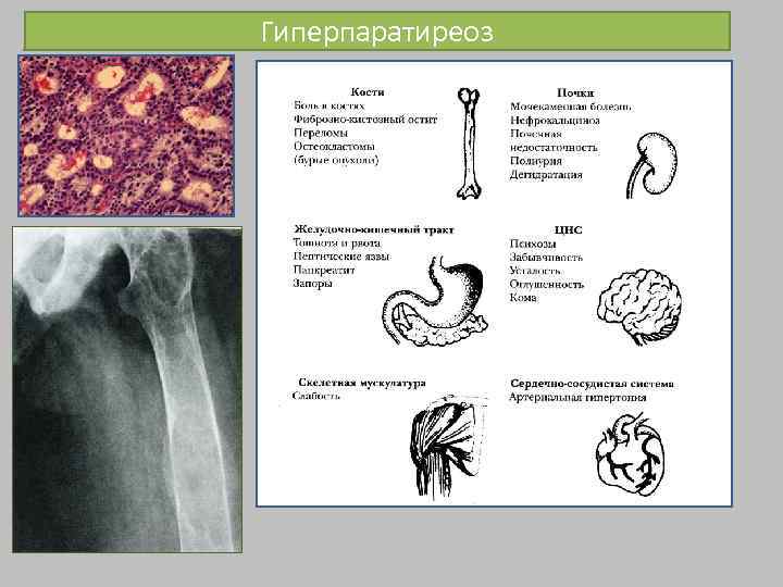 Гиперпаратиреоз причины