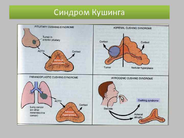 Синдром Кушинга 