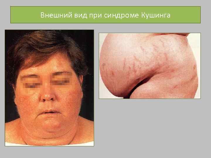 Внешний вид при синдроме Кушинга 