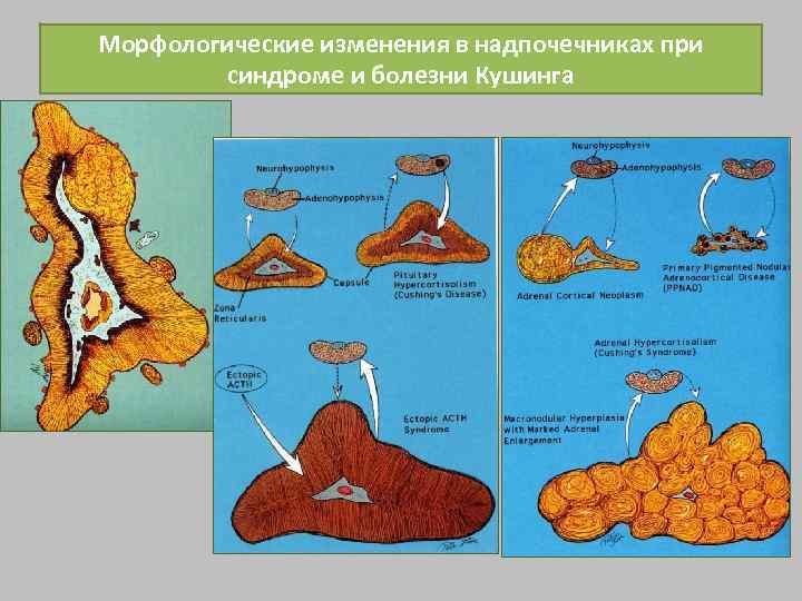 Морфологические изменения в надпочечниках при синдроме и болезни Кушинга 