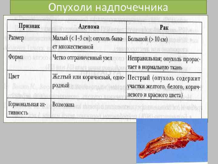 Опухоли надпочечника 