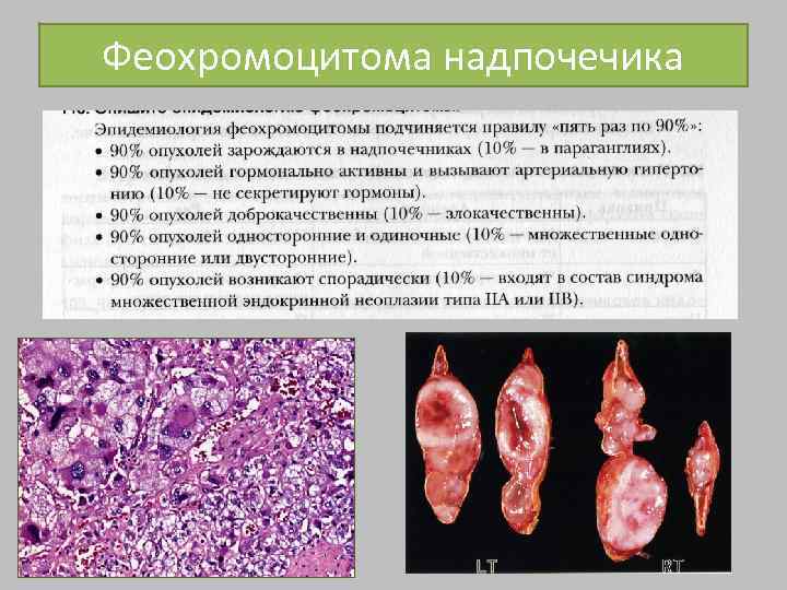 Гормонально активные опухоли надпочечников