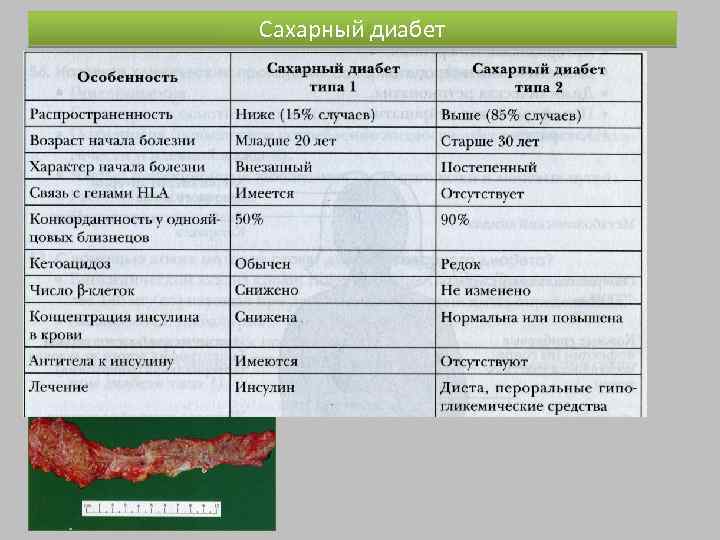 Сахарный диабет 