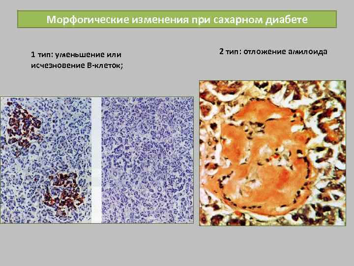 Морфогические изменения при сахарном диабете 1 тип: уменьшение или исчезновение В-клеток; 2 тип: отложение