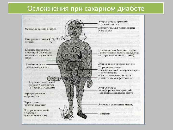 Осложнения при сахарном диабете 