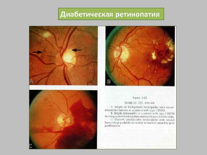 Диабетическая ретинопатия 