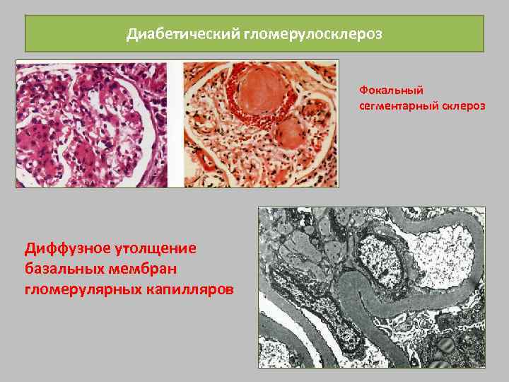 Диабетический гломерулосклероз Фокальный сегментарный склероз Диффузное утолщение базальных мембран гломерулярных капилляров 