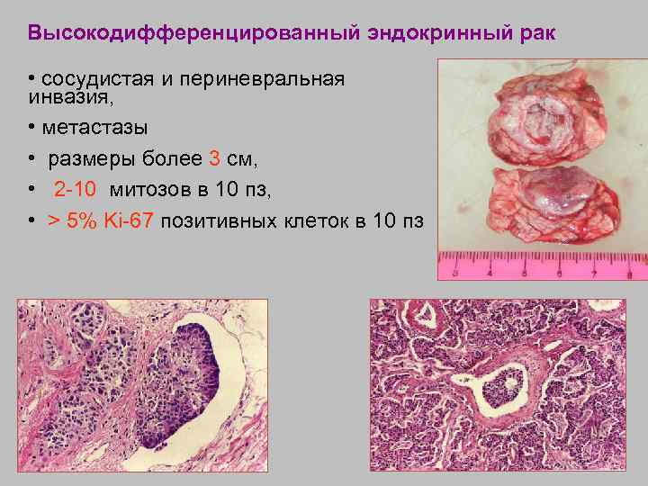 Высокодифференцированный эндокринный рак • сосудистая и периневральная инвазия, • метастазы • размеры более 3