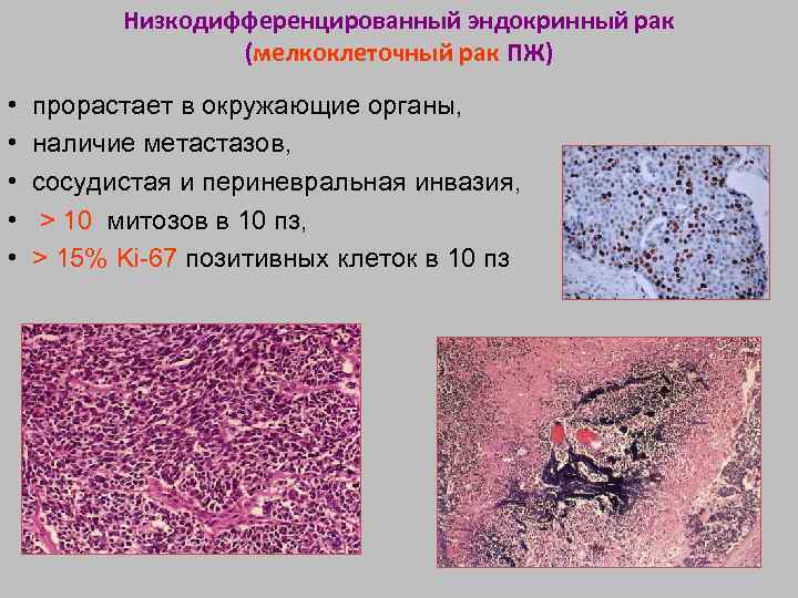 Инвазия в онкологии что это простыми словами