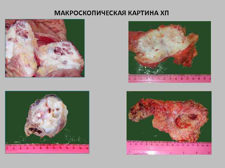 МАКРОСКОПИЧЕСКАЯ КАРТИНА ХП 
