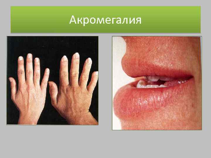 Акромегалия 