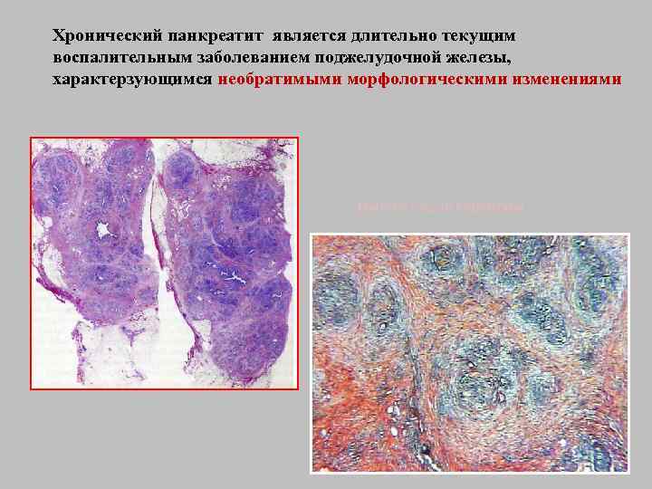 Хронический панкреатит является длительно текущим воспалительным заболеванием поджелудочной железы, характерзующимся необратимыми морфологическими изменениями Импрегнация