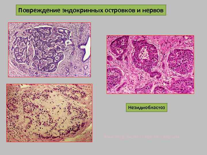 Повреждение эндокринных островков и нервов Незидиобластоз Амилоид, окраска Конго-красным 