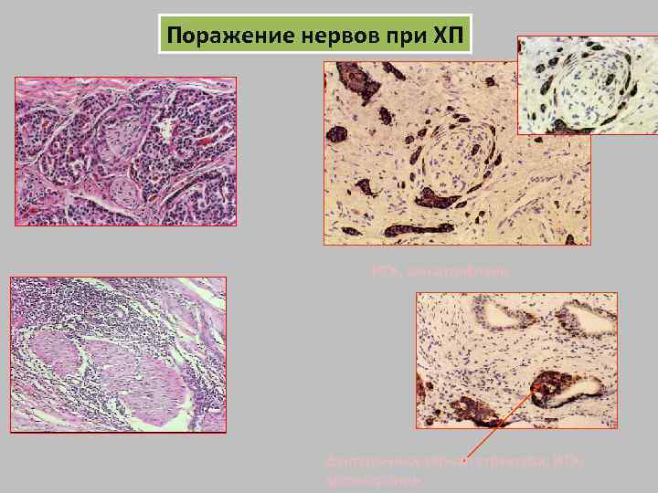 Поражение нервов при ХП ИГХ, синаптофизин Дуктуло-инсулярная структура, ИГХ, хромогранин 