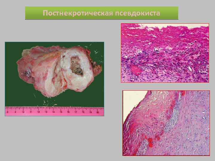 Постнекротическая псевдокиста 