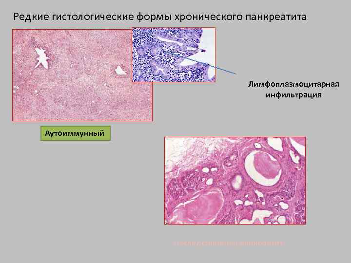Редкие гистологические формы хронического панкреатита Лимфоплазмоцитарная инфильтрация Аутоиммунный Наследственный панкреатит 