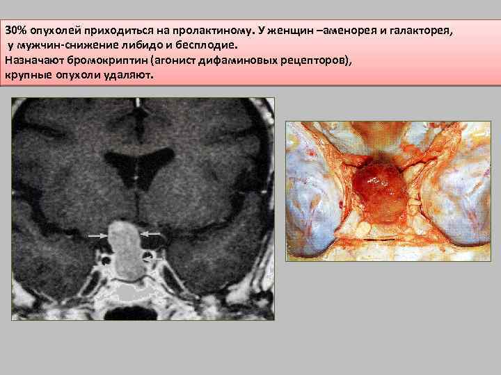 30% опухолей приходиться на пролактиному. У женщин –аменорея и галакторея, у мужчин-снижение либидо и
