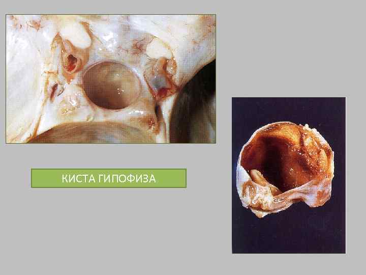 КИСТА ГИПОФИЗА 