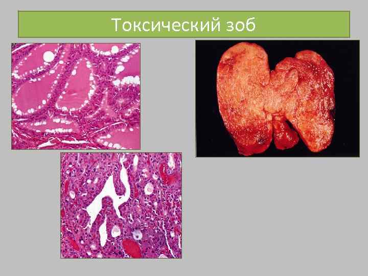 Токсический зоб 