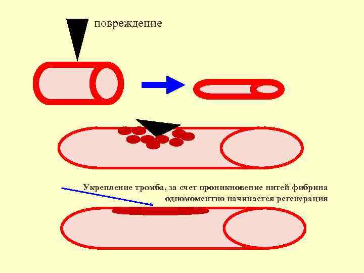 повреждение Укрепление тромба, за счет проникновение нитей фибрина одномоментно начинается регенерация 