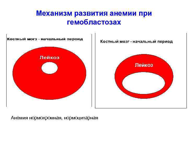 Механизм развития анемии при гемобластозах Костный мозг - начальный период Лейкоз Анемия нормохромная, нормоцитарная