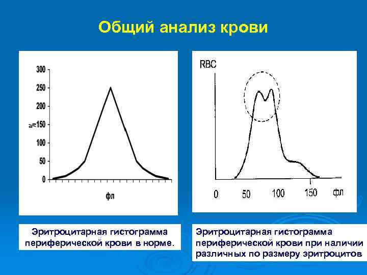 Предел нормального. Лейкоцитарная гистограмма норма. Эритроцитарная гистограмма в норме и при патологии. Гистограмма объема эритроцитов. Гистограмма распределения лейкоцитов.