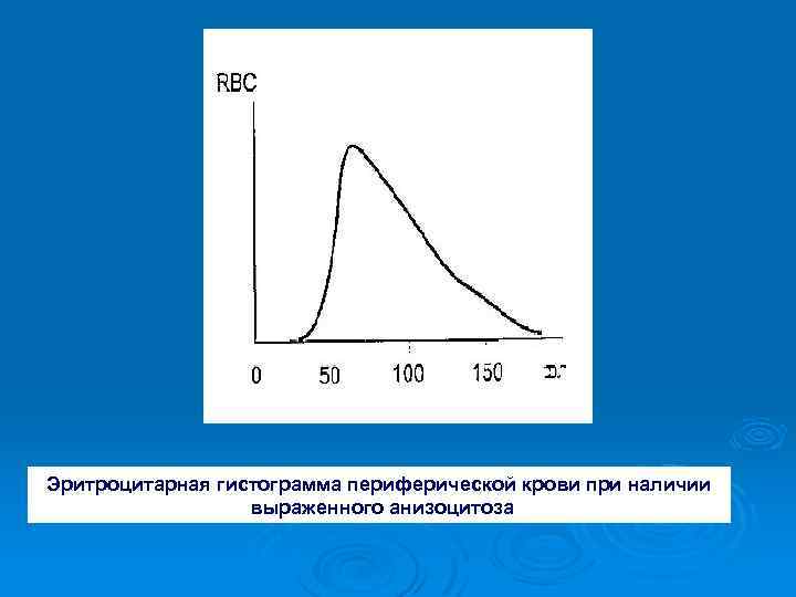 Эритроцитарная гистограмма периферической крови при наличии выраженного анизоцитоза 