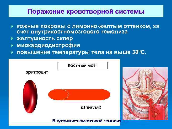 Поражение кроветворной системы кожные покровы с лимонно-желтым оттенком, за счет внутрикостномозгового гемолиза Ø желтушность