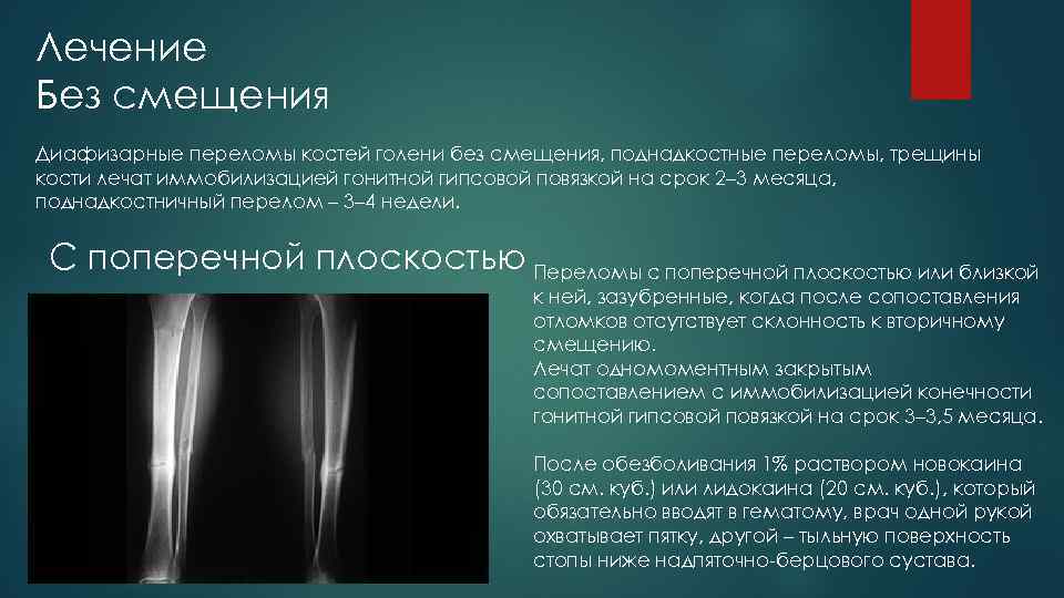 Лечение Без смещения Диафизарные переломы костей голени без смещения, поднадкостные переломы, трещины кости лечат