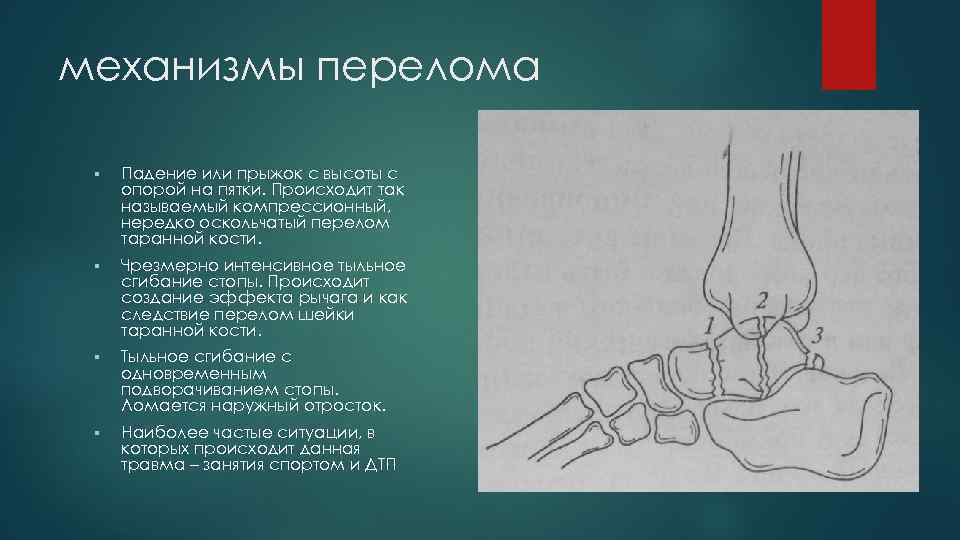 механизмы перелома § Падение или прыжок с высоты с опорой на пятки. Происходит так